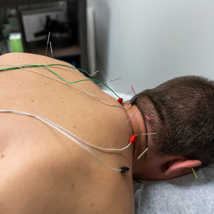 Acupuncture needles on neck