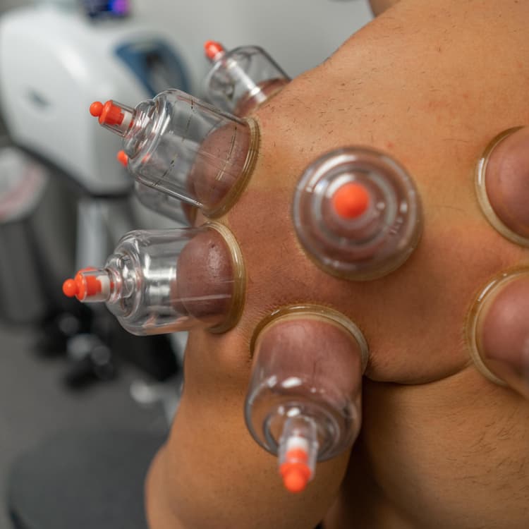 Person receiving cupping therapy