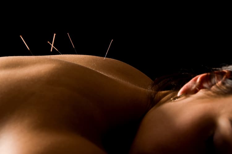 Person receiving dry needling