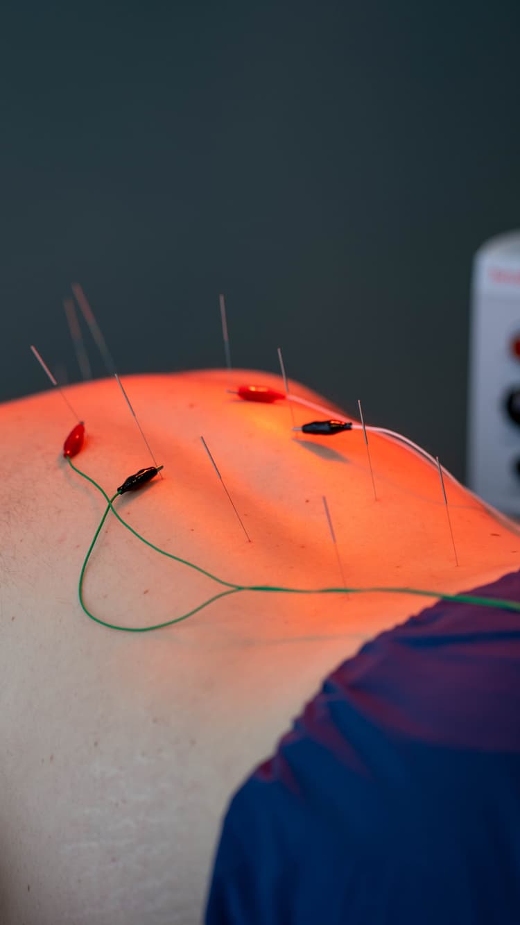 Person receiving electro acupuncture