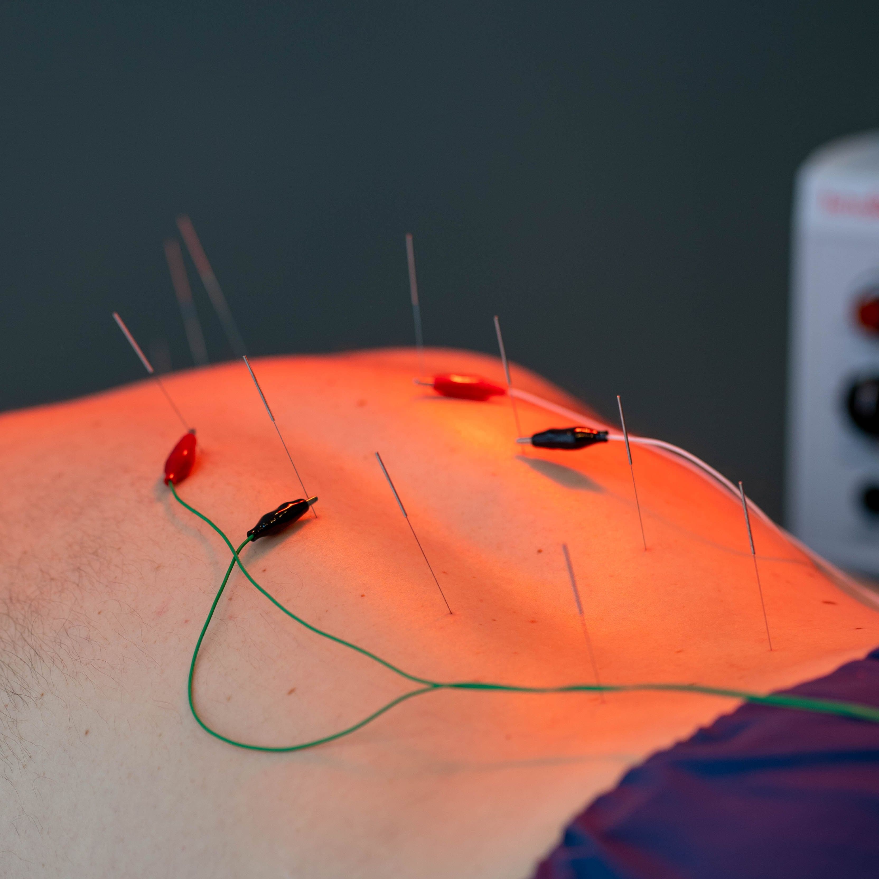 Electro-acupuncture