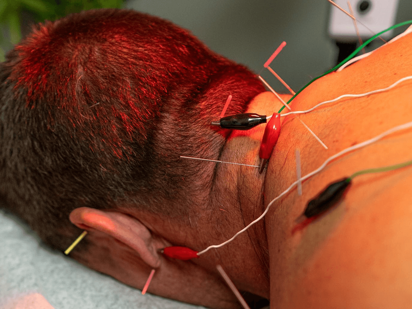 Acupuncture