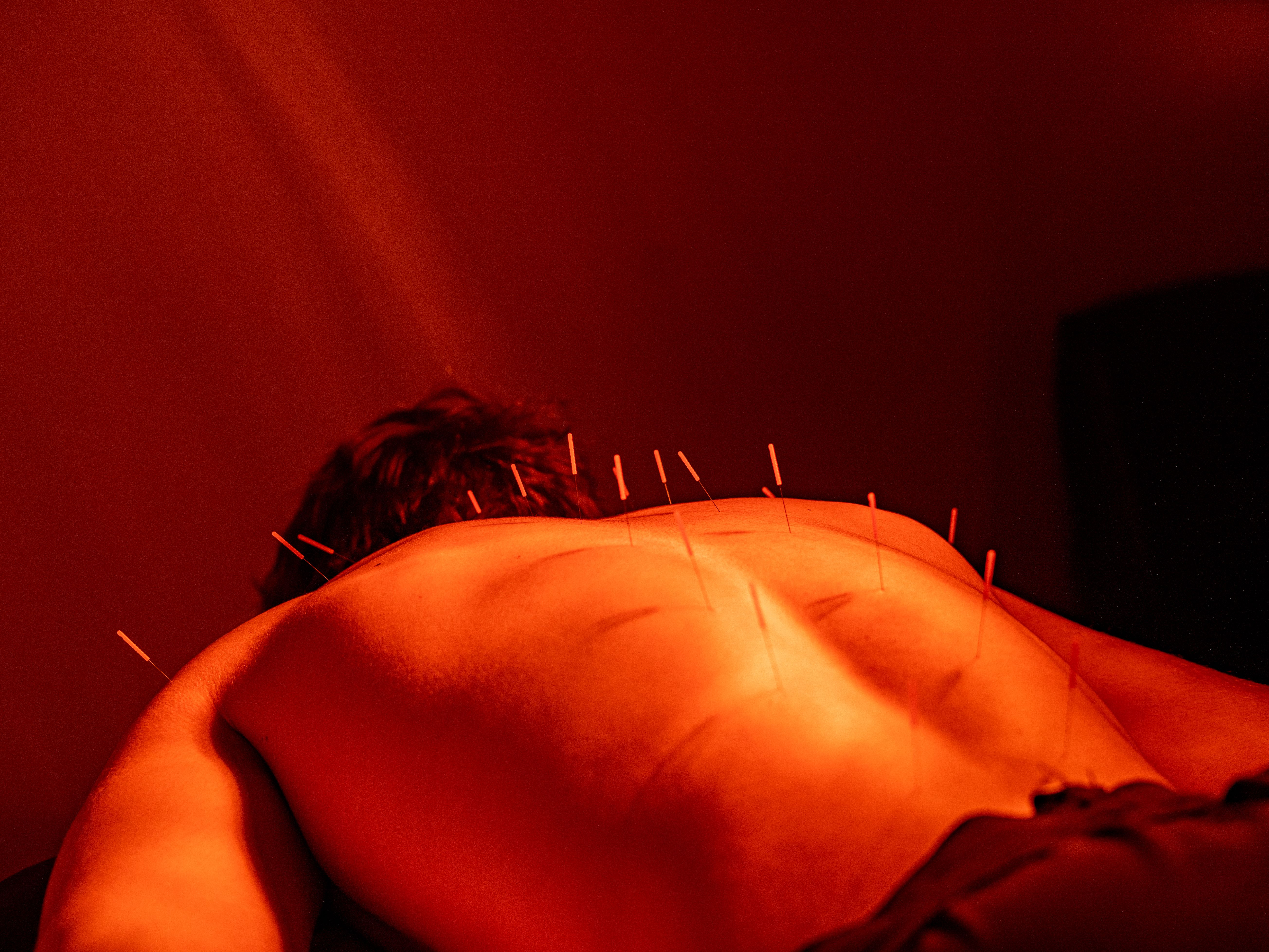 Person lying face down receiving acupuncture along the back and shoulders under warm red lighting